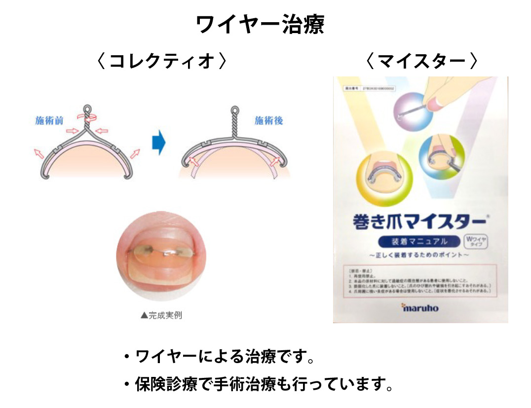 巻き爪ワイヤー治療