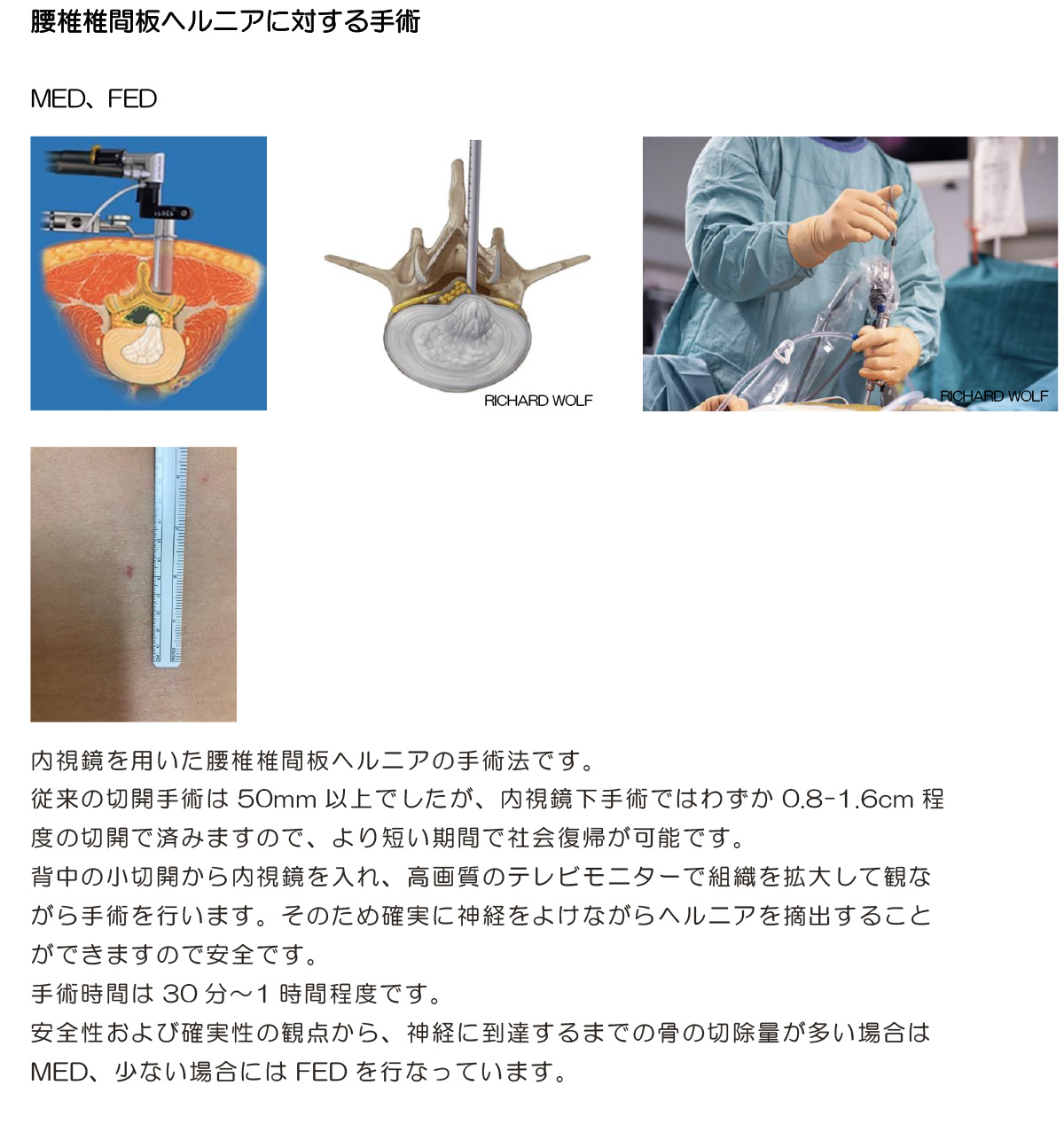 腰椎椎間板ヘルニアに対する手術