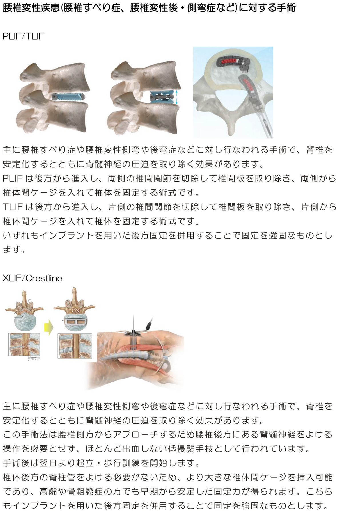 腰椎変性すべり症、腰椎変性後・側弯症などに対する手術